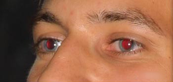 vörös szem